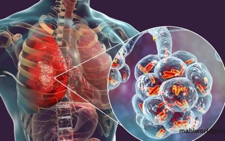 Legionnaires Disease